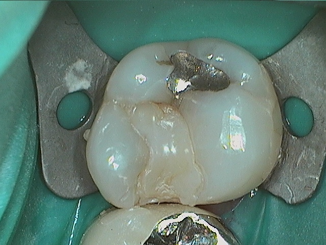 Bill Amalgam Composite Before