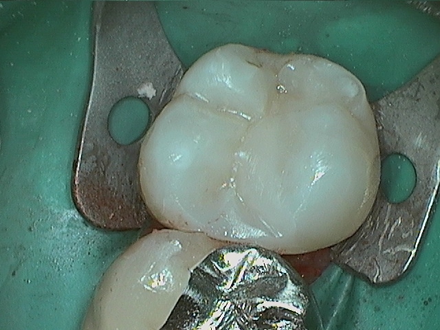 Bill Amalgam Composite During.jpg