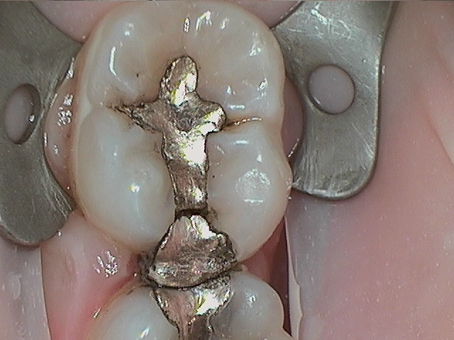 Chris 18 Amalgam Replacement Before