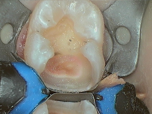 Chris 18 Amalgam Replacement During