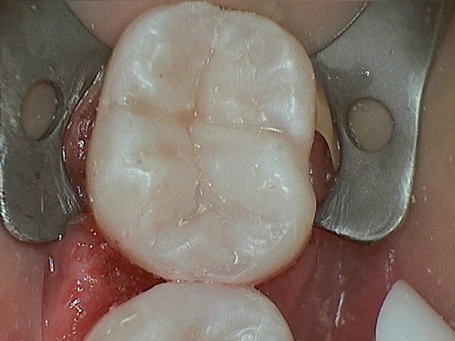 Chris 19 Amalgam Replacement After