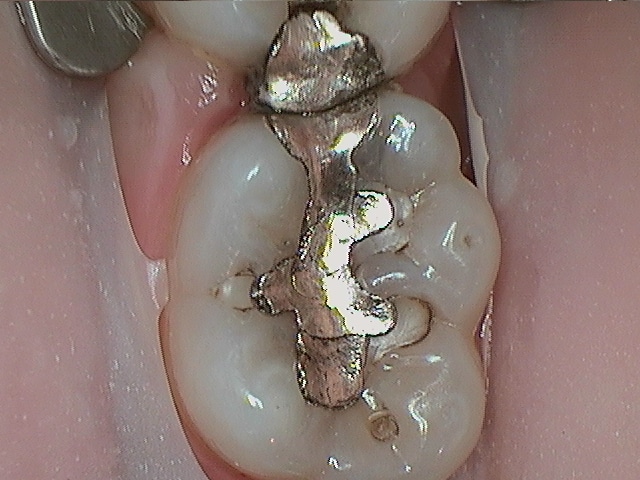 Chris 19 Amalgam Replacement Before