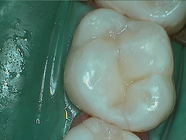 David 2failing Amalgams After Photo2