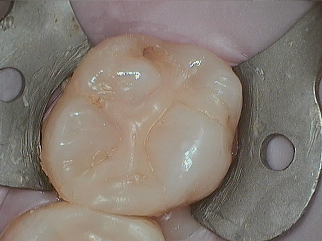 Johnson 15 Failing Composite Before1