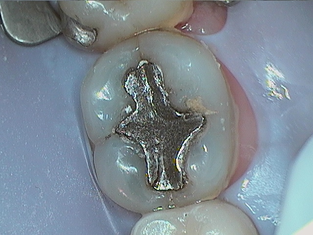 Mark Failing Amalgams Before Photo1