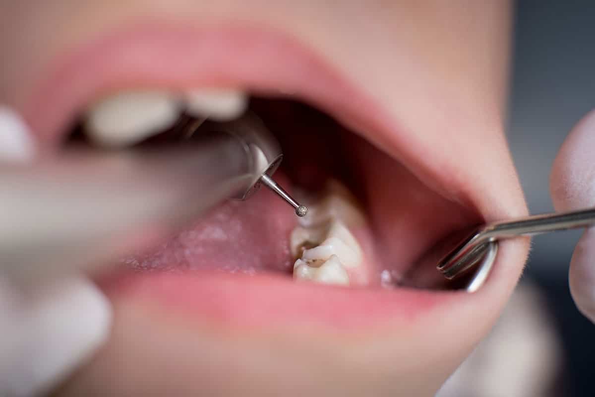 How Long Should Tooth Pain Last After A Dental Filling Blog